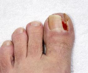 All About Ingrown Toenails: AllCare Foot & Ankle Center: Podiatry