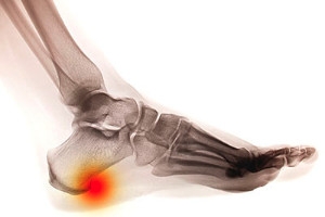 When Heel Spurs Become Painful