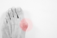 What You Need to Know About Your Bunion